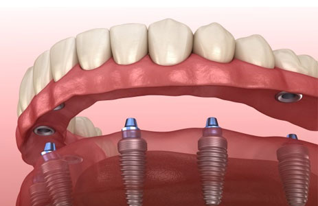 Full Mouth Dental Implants (All-on-4 / All-on-6 / 3-on-6 Systems)