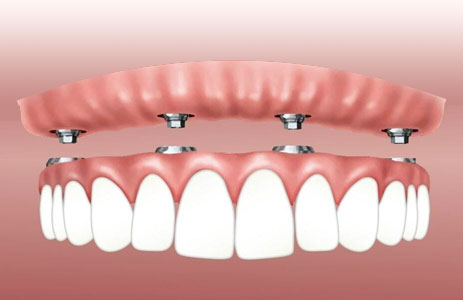 Implant-Supported Overdentures (Snap-On Dentures)