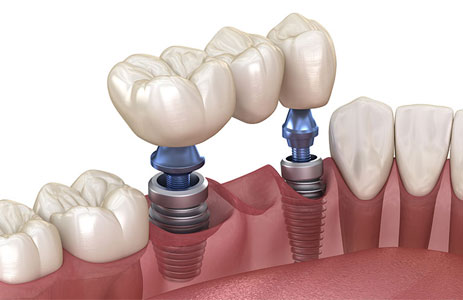 Multiple Tooth Replacement (Implant Bridge) When several teeth are missing in a row, implant-supported bridges restore your smile’s function and stability without the need for removable dentures.