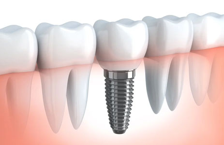 Single Tooth Implant