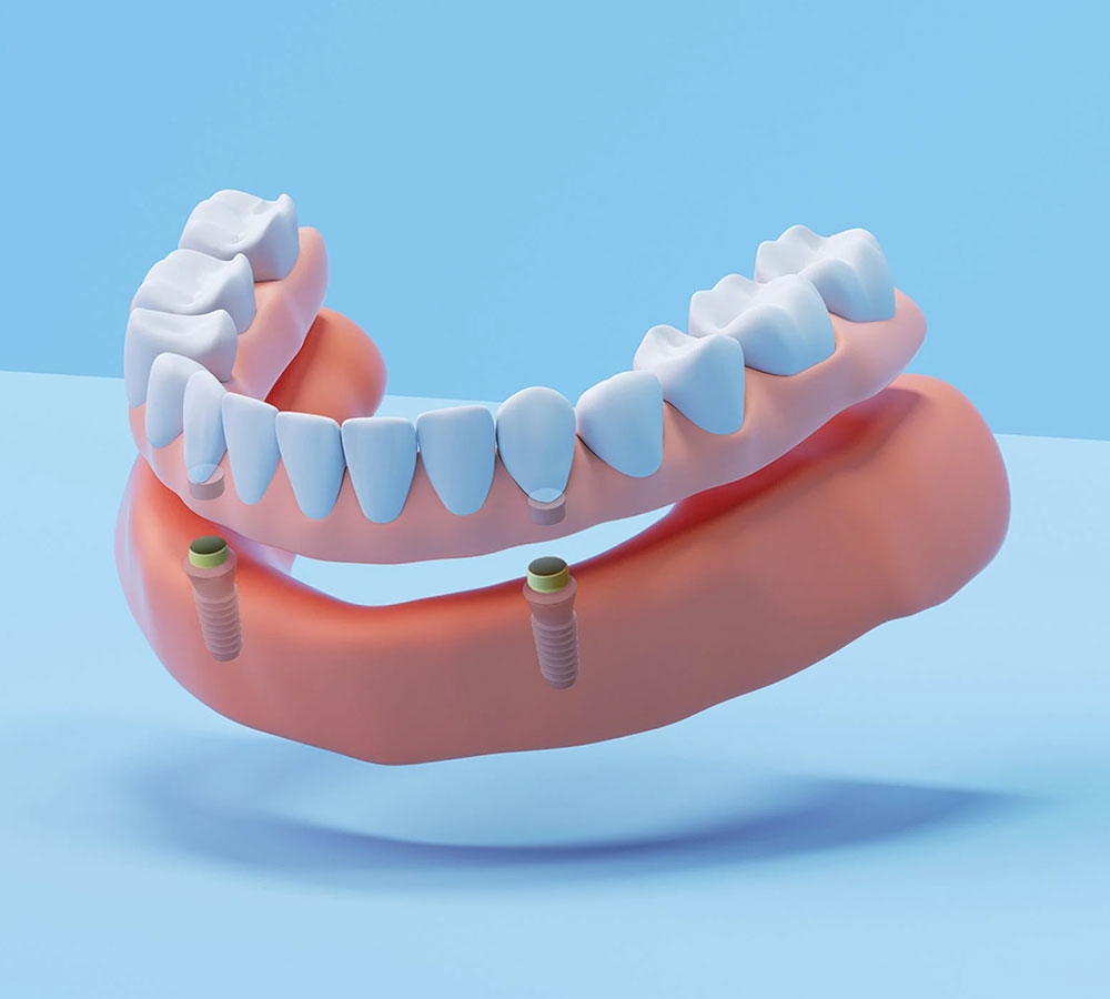 Snap-On Dentures Work