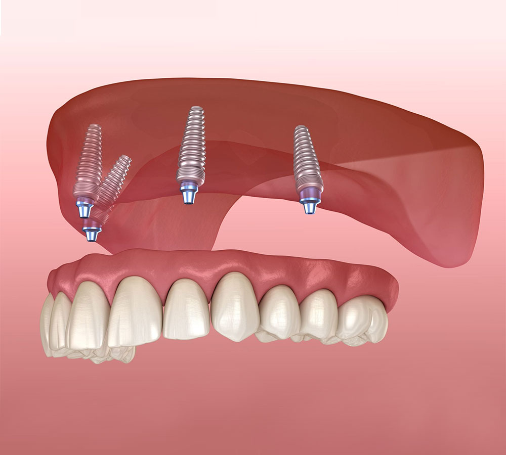 What Are Snap-On Dentures