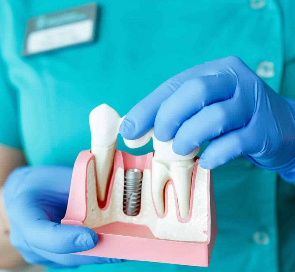 Why Choose Dental Implants